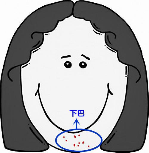 超全!脸部痘痘分析图 让它告诉你哪儿病了