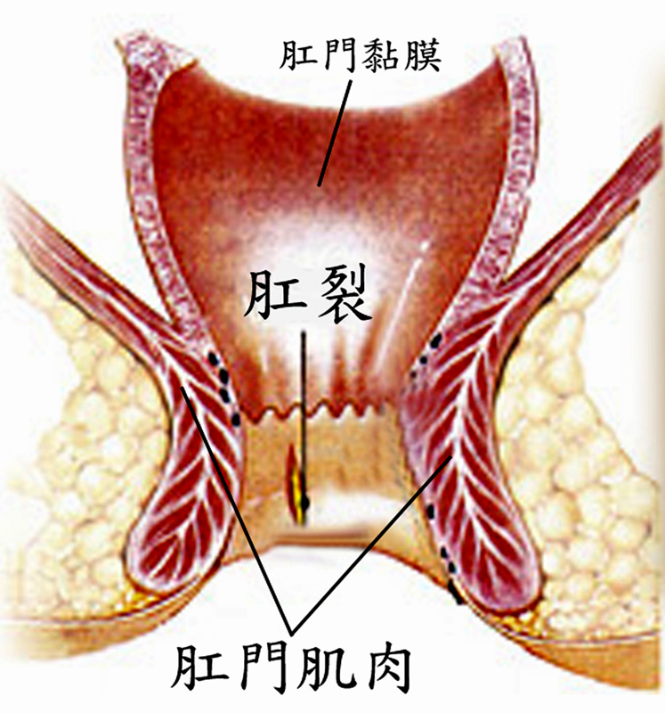 痔瘘专科 肛裂