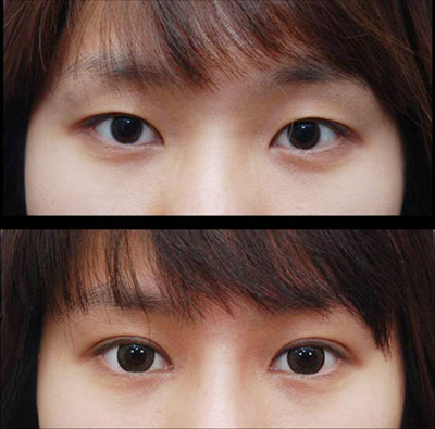 重庆做双眼皮多少钱-依雪整形割双眼皮-重庆依