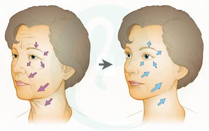 面部提升除皱是做手术吗