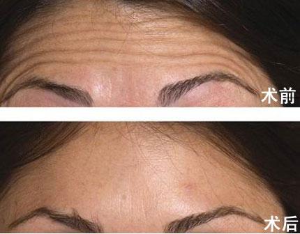 抬头纹如何去除最有效